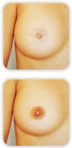areola01